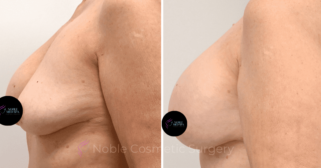 BREAST-AUGMENTATION-CASE-12085 | Before and After Breast Augmentation 4
