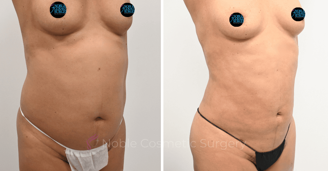 LIPOSUCTION-ABDOMEN-CASE-12162 | Before and After Liposuction