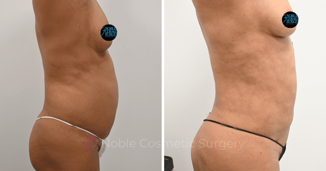 LIPOSUCTION-ABDOMEN-CASE-12162 | Before and After Liposuction 2
