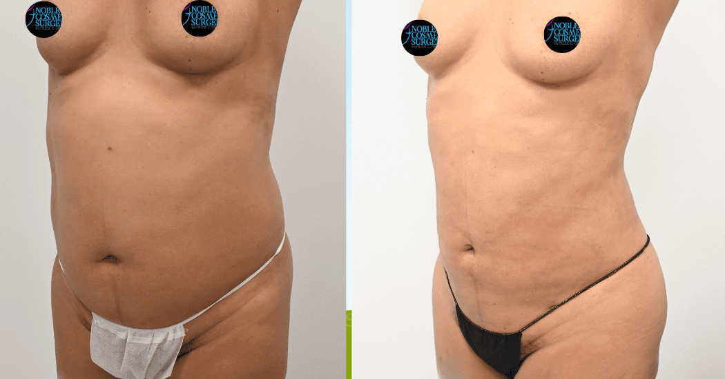 LIPOSUCTION-ABDOMEN-CASE-12162 | Before and After Liposuction 3