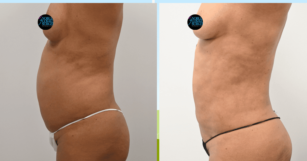 LIPOSUCTION-ABDOMEN-CASE-12162 | Before and After Liposuction 4