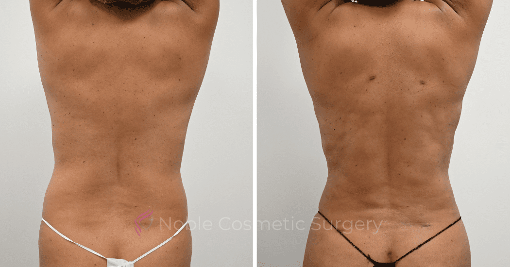 LIPOSUCTION-ABDOMEN-CASE-12162 | Before and After Liposuction 5