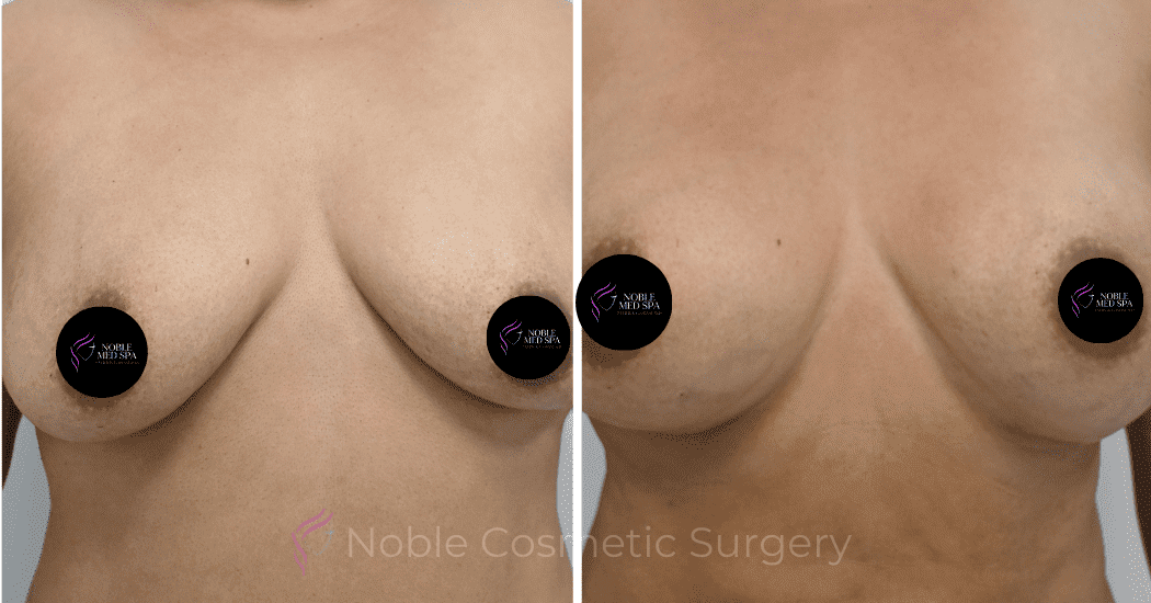 BREAST-AUGMENTATION-CASE-12466 | Before and After Breast Augmentation