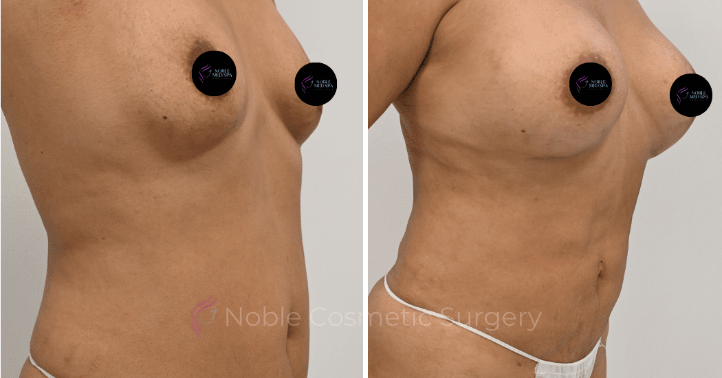 MOMMY-MAKEOVER-CASE-12466 | Before and After Mommy Makeover 2