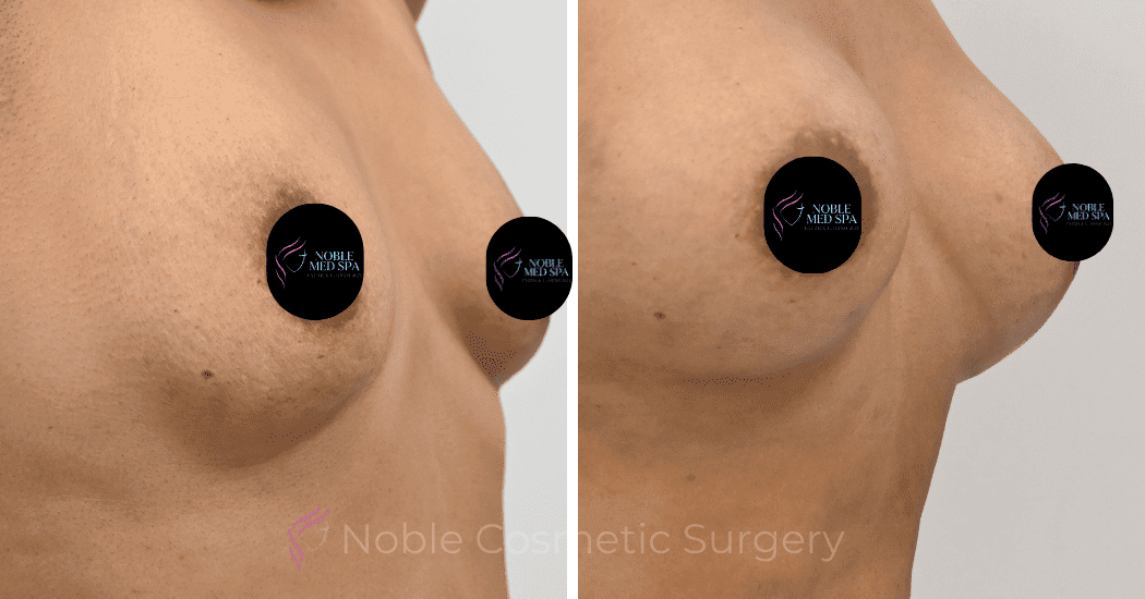 BREAST-AUGMENTATION-CASE-12466 | Before and After Breast Augmentation 3