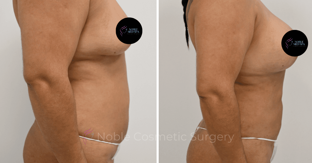 MOMMY-MAKEOVER-CASE-12466 | Before and After Mommy Makeover 3