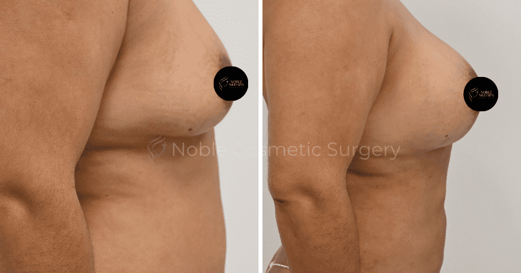 BREAST-AUGMENTATION-CASE-12466 | Before and After Breast Augmentation 2