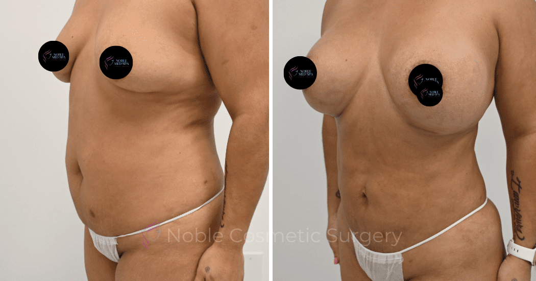 MOMMY-MAKEOVER-CASE-12466 | Before and After Mommy Makeover 4