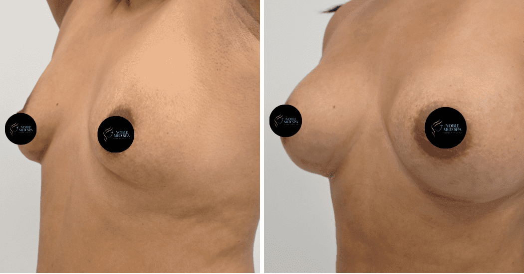BREAST-AUGMENTATION-CASE-12466 | Before and After Breast Augmentation 4