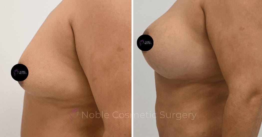 MOMMY-MAKEOVER-CASE-12466 | Before and After Mommy Makeover 5