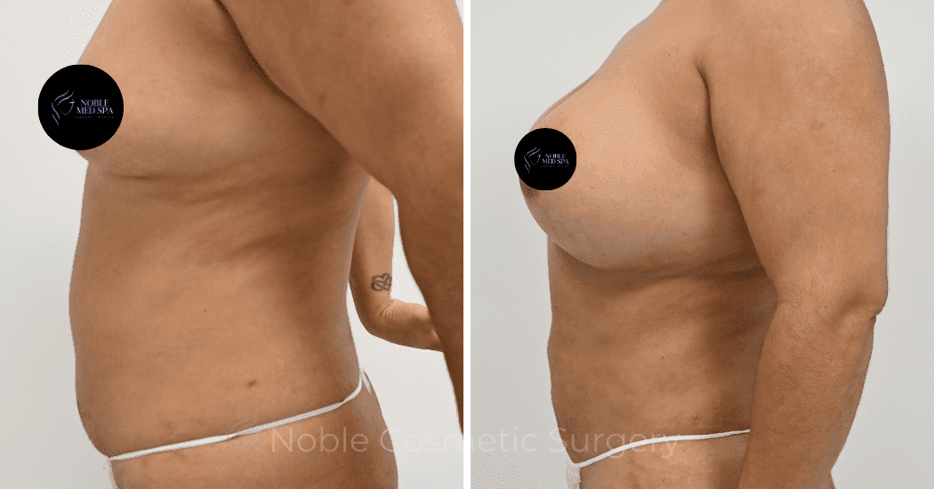 BREAST-AUGMENTATION-CASE-12466 | Before and After Breast Augmentation 5