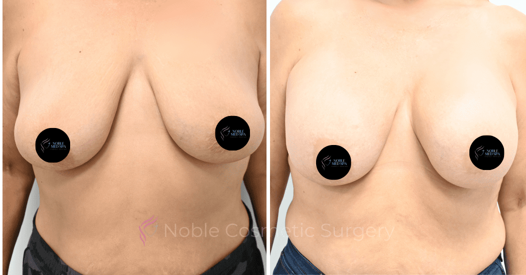 BREAST-AUGMENTATION-CASE-12478 | Before and After Breast Augmentation 4