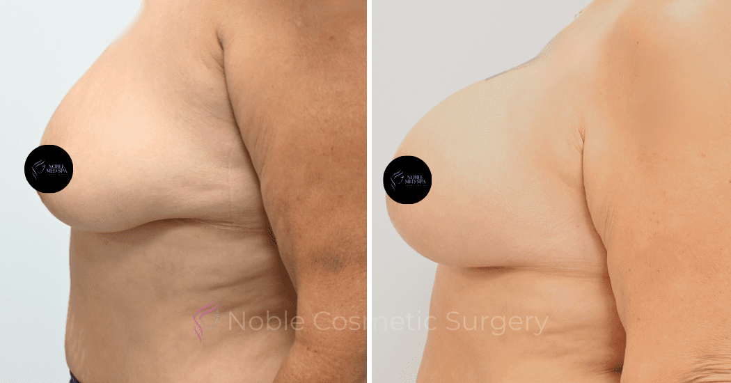 BREAST-AUGMENTATION-CASE-12478 | Before and After Breast Augmentation 5