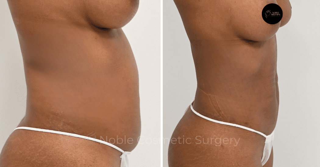 LIPOSUCTION-ABDOMEN-CASE-12590 | Before and After Liposuction 3