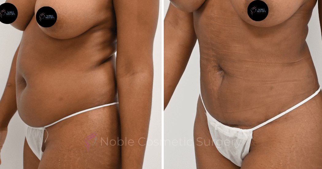 LIPOSUCTION-ABDOMEN-CASE-12590 | Before and After Liposuction 4