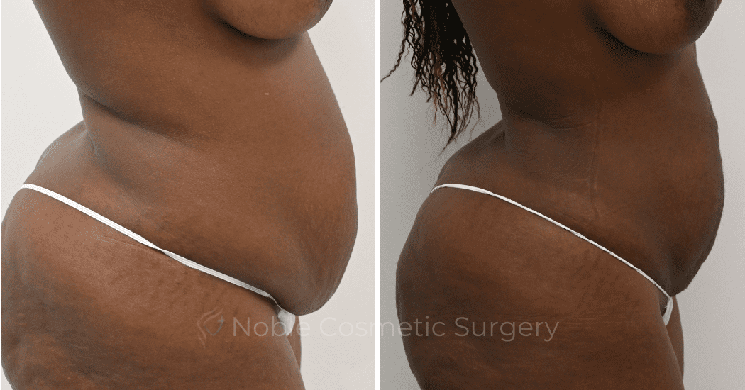 LIPOSUCTION-ABDOMEN-CASE-12901 | Before and After Liposuction 3