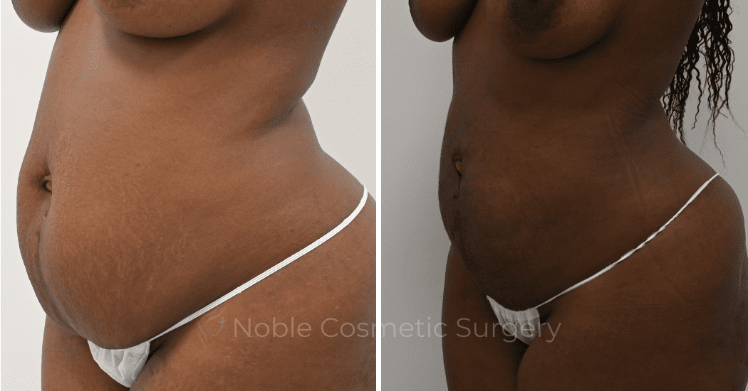 LIPOSUCTION-ABDOMEN-CASE-12901 | Before and After Liposuction 4