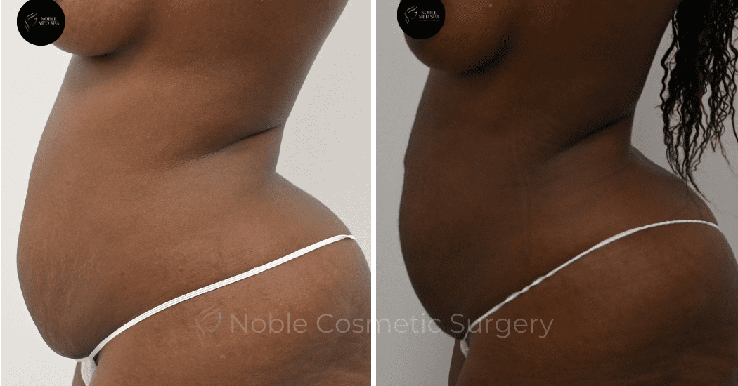 LIPOSUCTION-ABDOMEN-CASE-12901 | Before and After Liposuction 5