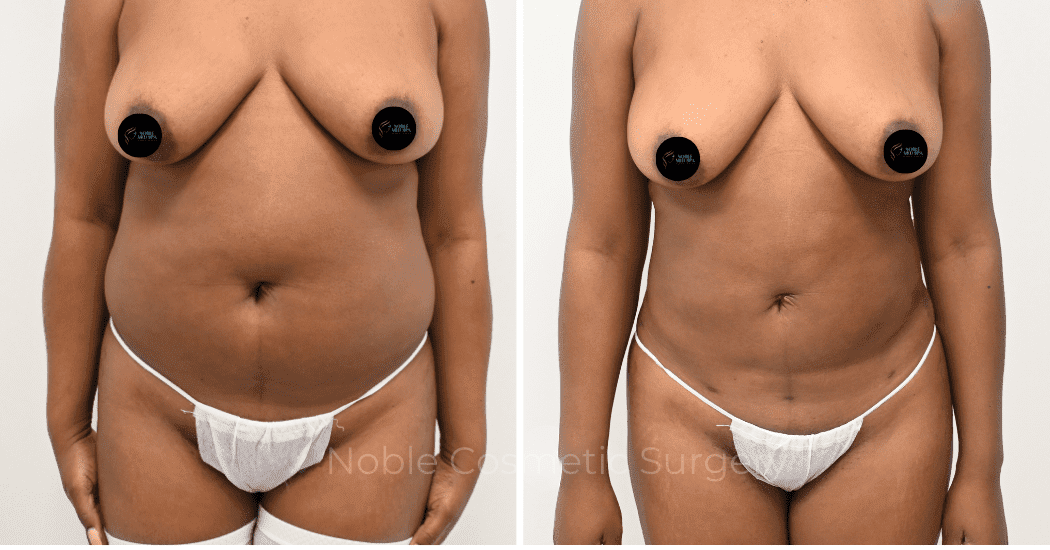 LIPOSUCTION-CASE-12998 | Before and After Liposuction