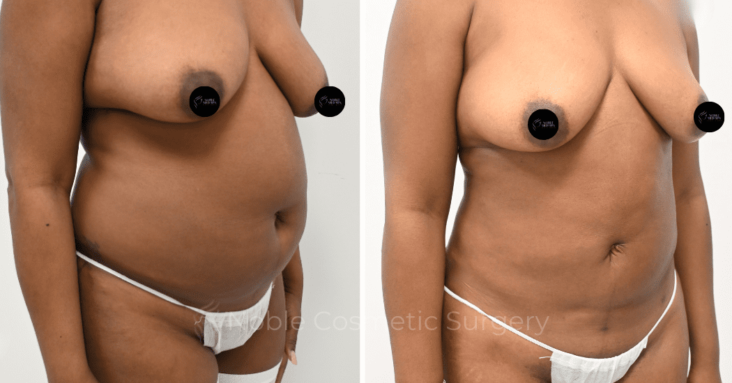 LIPOSUCTION-CASE-12998 | Before and After Liposuction 2