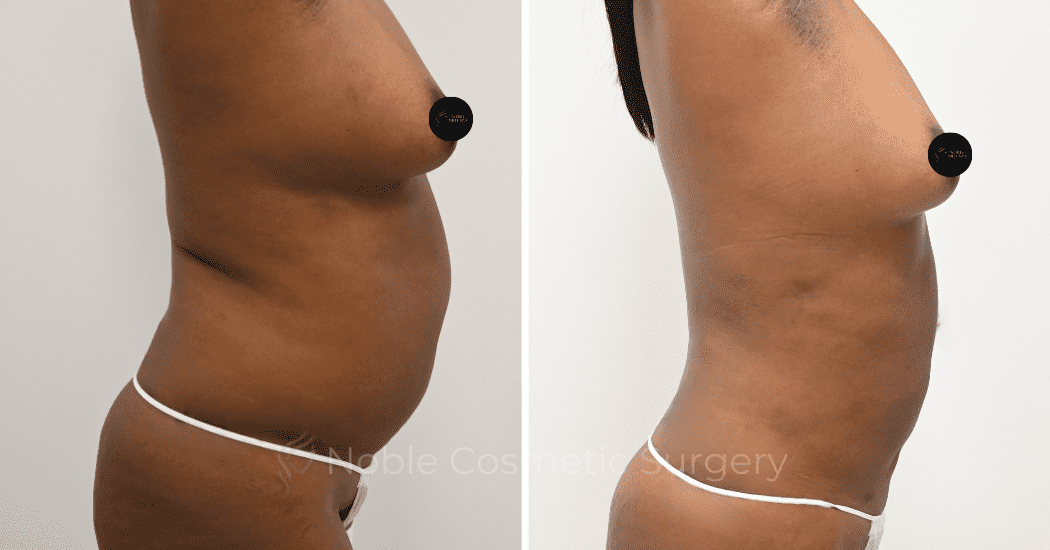 LIPOSUCTION-CASE-12998 | Before and After Liposuction 3