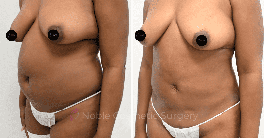 LIPOSUCTION-CASE-12998 | Before and After Liposuction 4