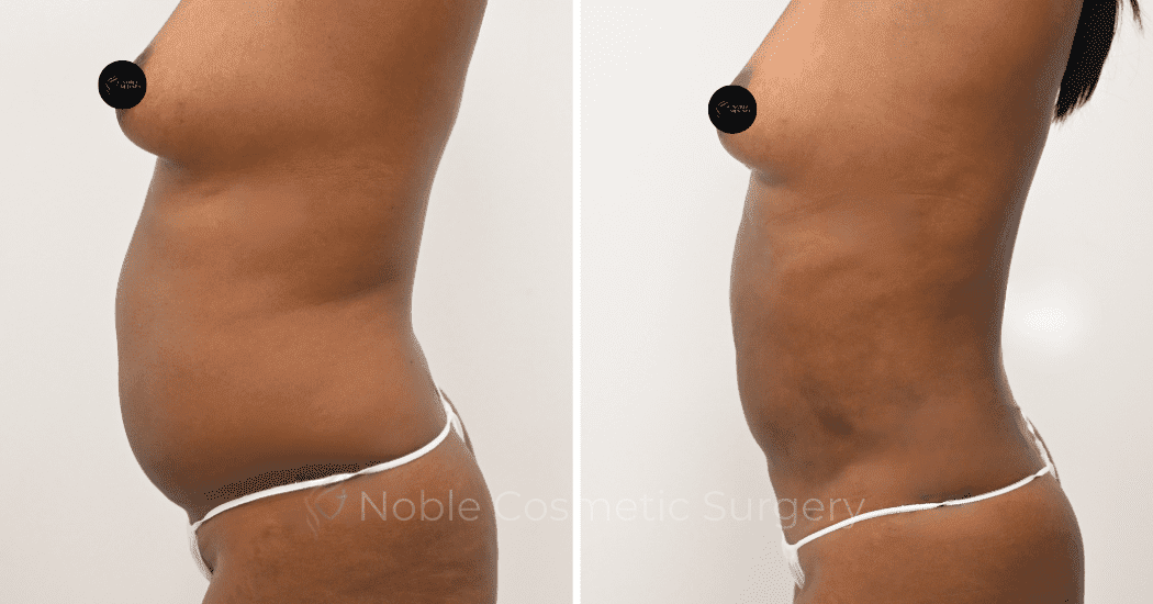 LIPOSUCTION-CASE-12998 | Before and After Liposuction 5