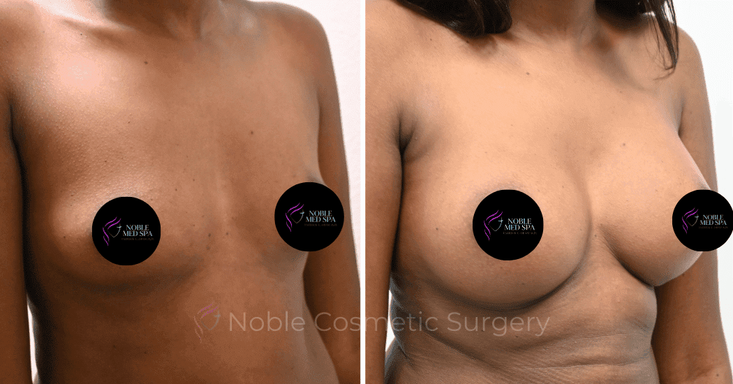 BREAST-AUGMENTATION-CASE-13251 | Before and After Breast Augmentation 2