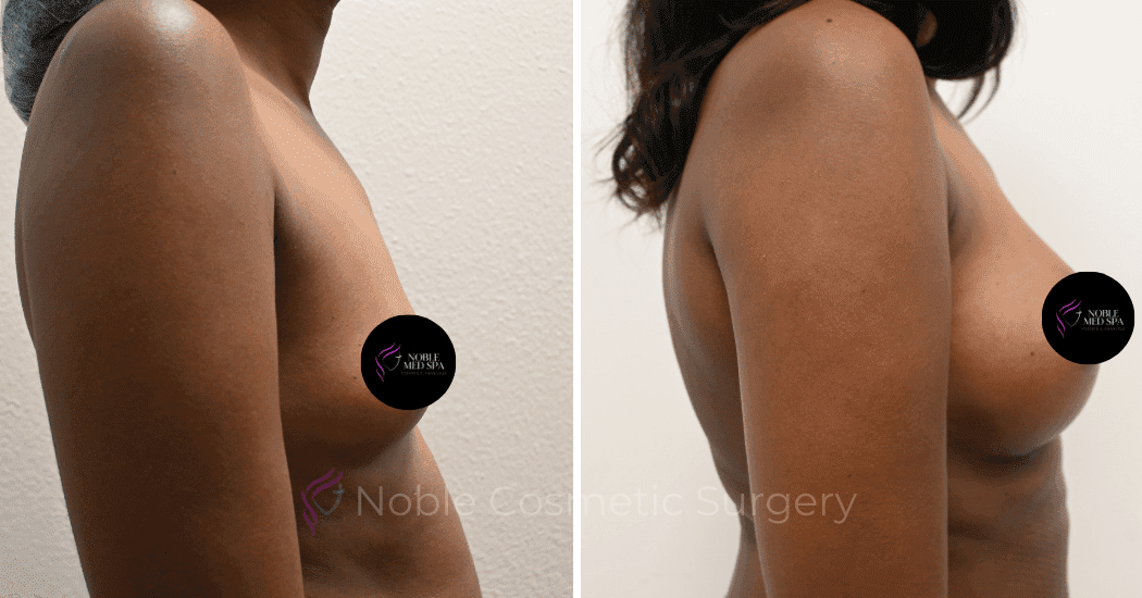 BREAST-AUGMENTATION-CASE-13251 | Before and After Breast Augmentation 3