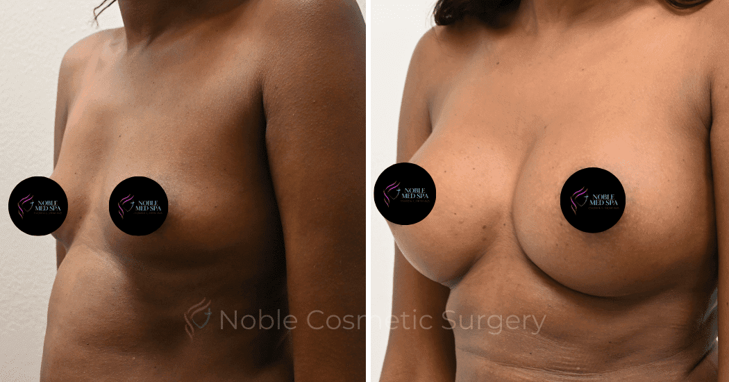 BREAST-AUGMENTATION-CASE-13251 | Before and After Breast Augmentation 4