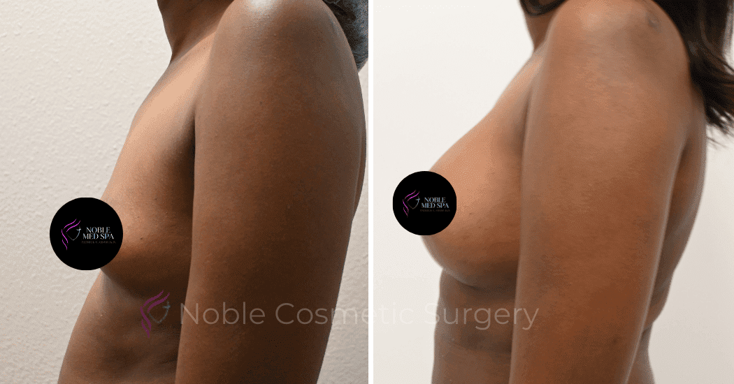 BREAST-AUGMENTATION-CASE-13251 | Before and After Breast Augmentation 5
