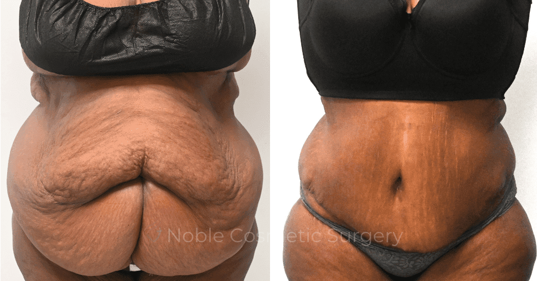 TUMMY-TUCK-CASE-14955 | Before and After Abdominoplasty