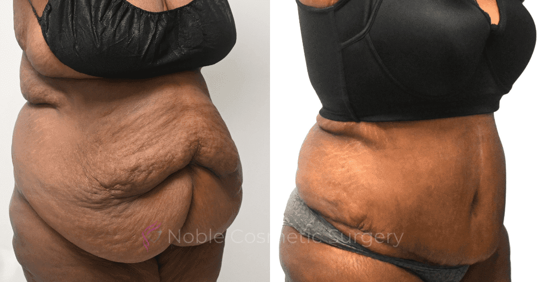 TUMMY-TUCK-CASE-14955 | Before and After Abdominoplasty 2