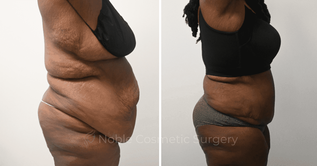 TUMMY-TUCK-CASE-14955 | Before and After Abdominoplasty 5