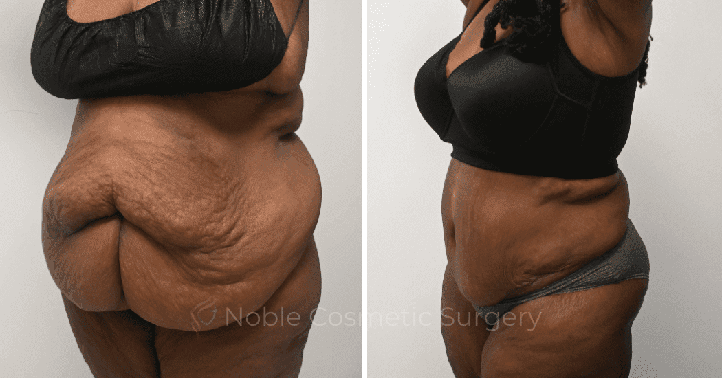 TUMMY-TUCK-CASE-14955 | Before and After Abdominoplasty 3
