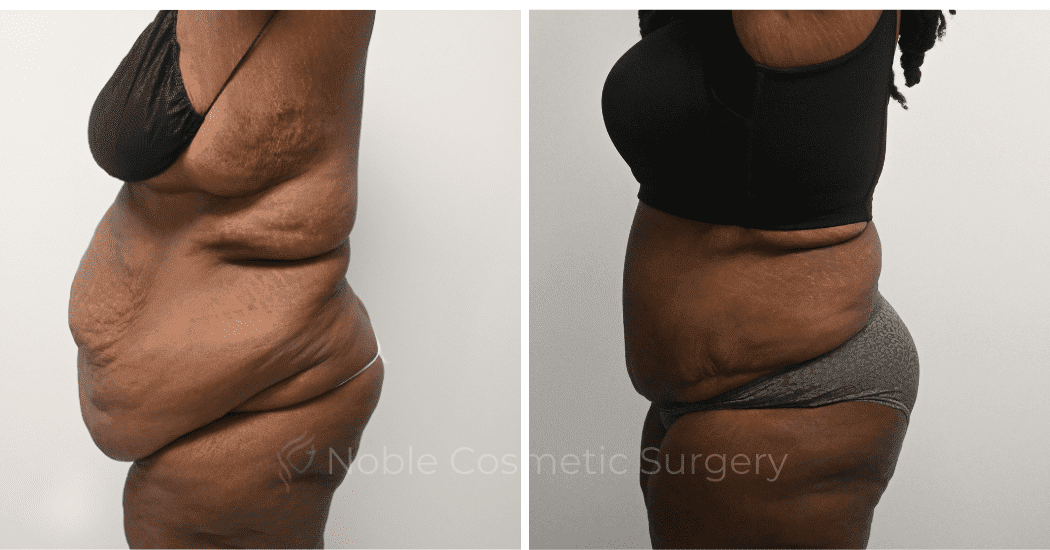 TUMMY-TUCK-CASE-14955 | Before and After Abdominoplasty 4