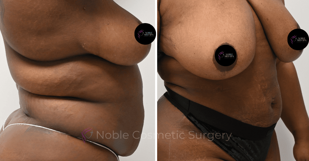 LIPOSUCTION-ABDOMEN-CASE-15837 | Before and After Liposuction 3