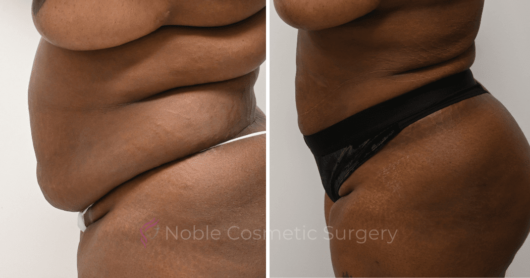 LIPOSUCTION-ABDOMEN-CASE-15837 | Before and After Liposuction 4