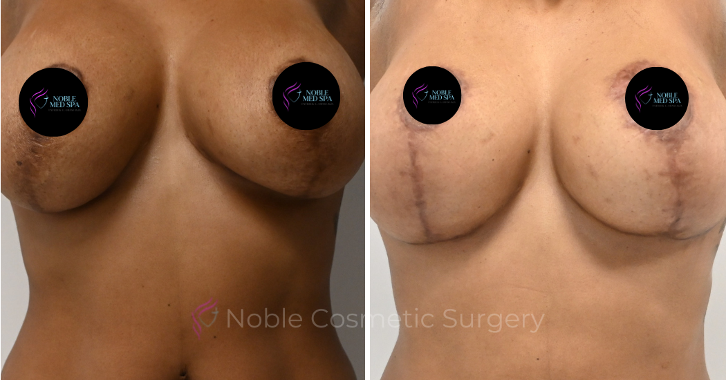 BREAST-AUGMENTATION--WITH-LIFT--CASE-16458 | Before and After Breast Augmentation with Lift