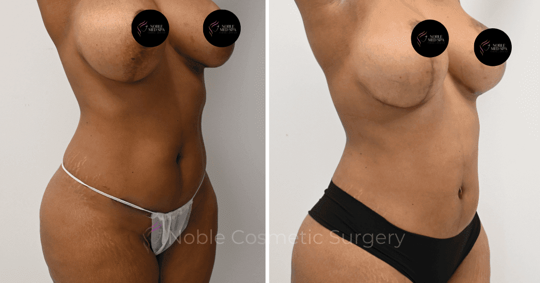 MOMMY-MAKEOVER-CASE-16458 | Before and After Mommy Makeover 2