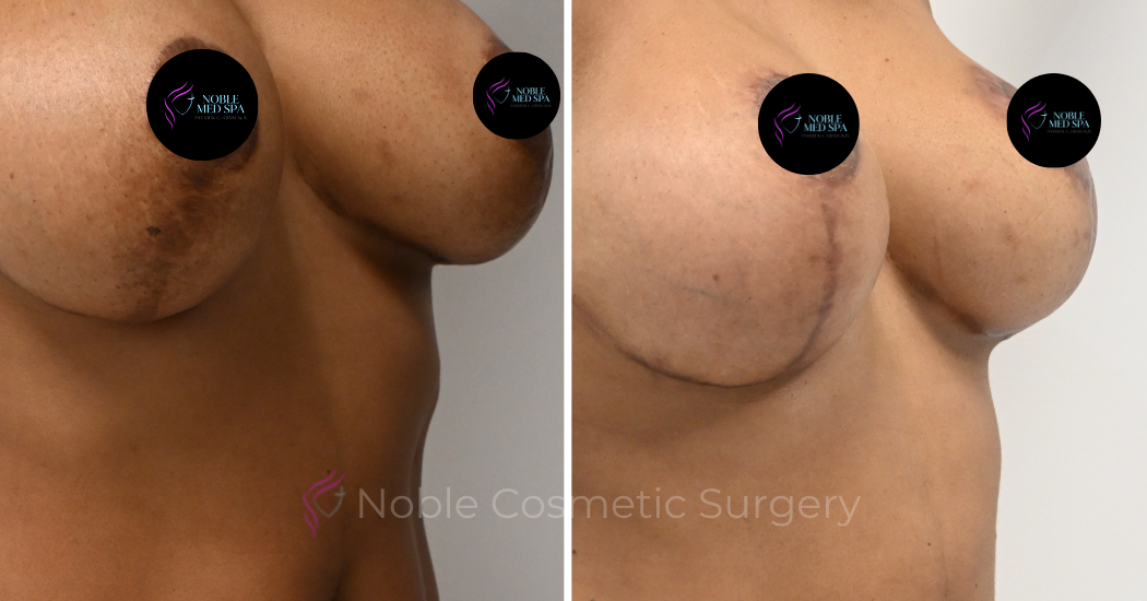 BREAST-AUGMENTATION--WITH-LIFT--CASE-16458 | Before and After Breast Augmentation with Lift 2