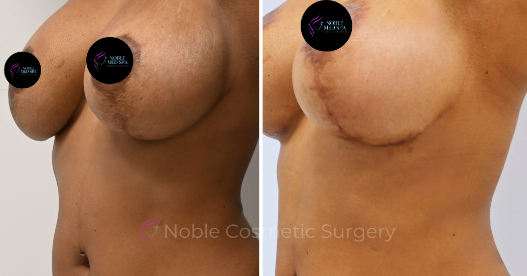 BREAST-AUGMENTATION--WITH-LIFT--CASE-16458 | Before and After Breast Augmentation with Lift 3