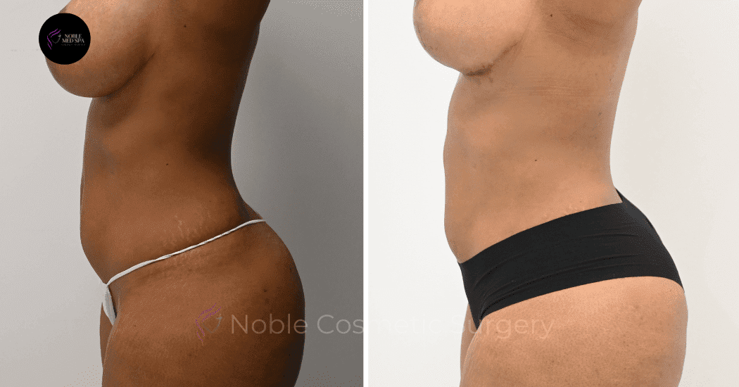 MOMMY-MAKEOVER-CASE-16458 | Before and After Mommy Makeover 5