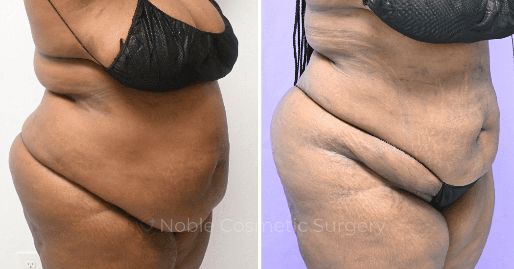 LIPOSUCTION-ABDOMEN-CASE-19096 | Before and After Liposuction 2