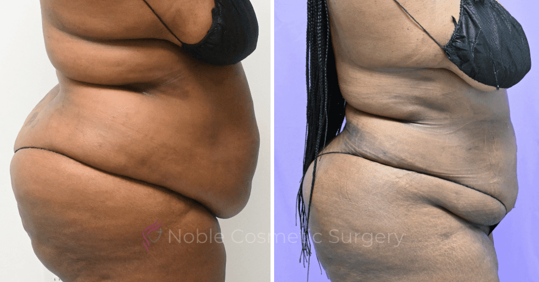 LIPOSUCTION-ABDOMEN-CASE-19096 | Before and After Liposuction 3