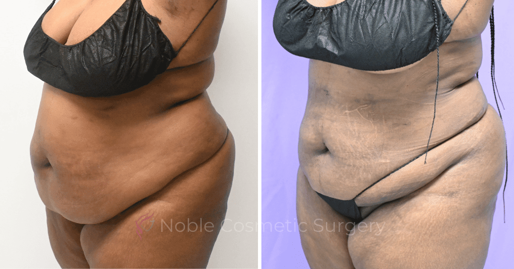 LIPOSUCTION-ABDOMEN-CASE-19096 | Before and After Liposuction 4