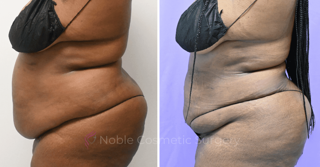 LIPOSUCTION-ABDOMEN-CASE-19096 | Before and After Liposuction 5