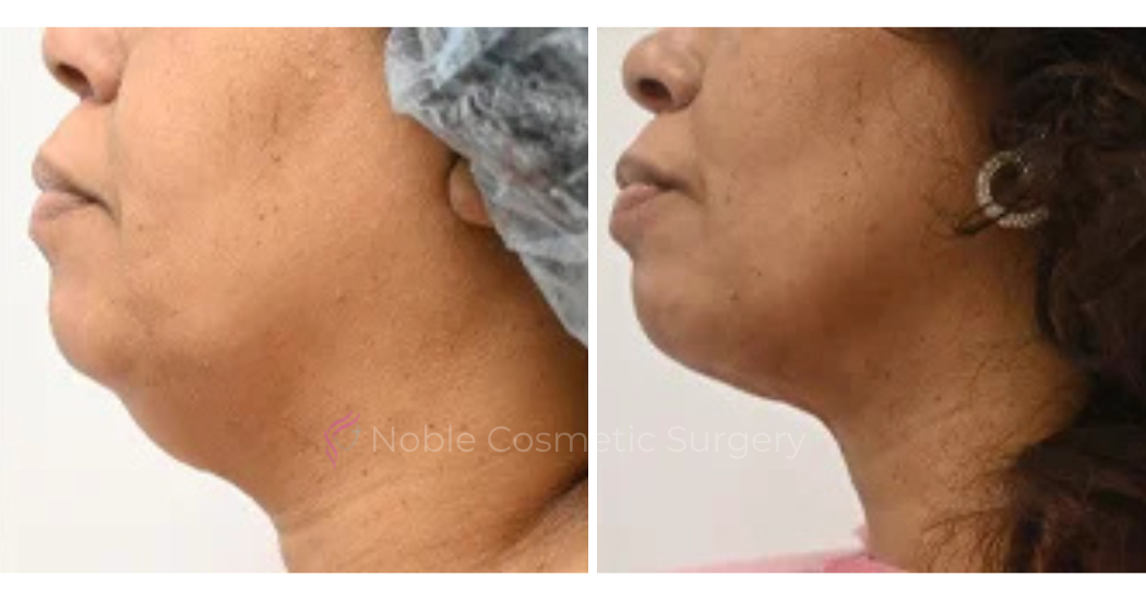 SUBMENTAL-LIPOSUCTION--CHIN--CASE-19224 | Before and After Chin Liposuction 2
