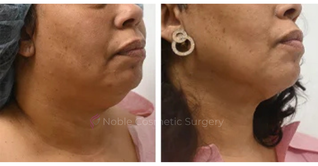 SUBMENTAL-LIPOSUCTION--CHIN--CASE-19224 | Before and After Chin Liposuction