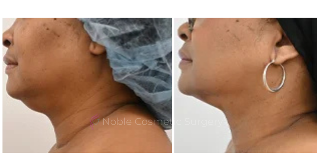 SUBMENTAL-LIPOSUCTION--CHIN--CASE-19225 | Before and After Chin Liposuction 2